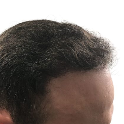 Hair Transplants Before & After Patient #3689
