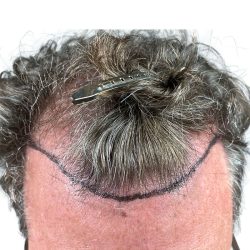 Hair Transplants Before & After Patient #3720