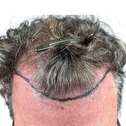 Hair Transplants Before & After Patient #3720