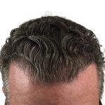 Hair Transplants Before & After Patient #3720