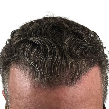Hair Transplants Before & After Patient #3720
