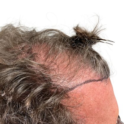 Hair Transplants Before & After Patient #3720