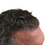 Hair Transplants Before & After Patient #3720