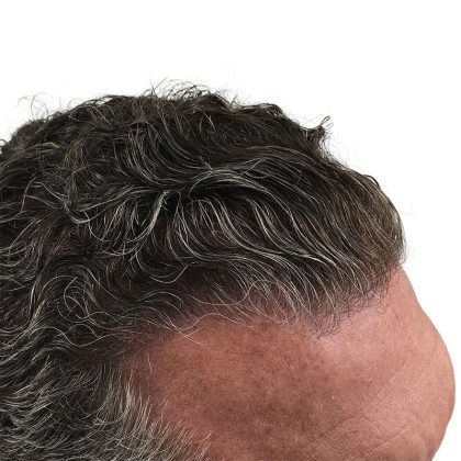 Hair Transplants Before & After Patient #3720