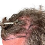 Hair Transplants Before & After Patient #3720