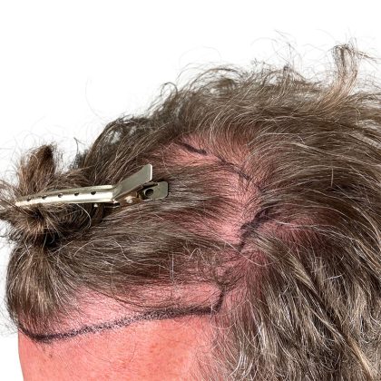 Hair Transplants Before & After Patient #3720