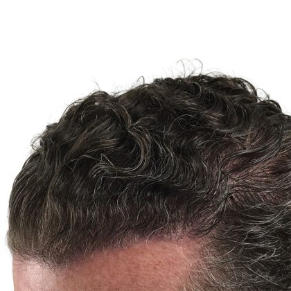 Hair Transplants Before & After Patient #3720
