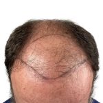 Hair Transplants Before & After Patient #3721