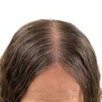 Hair Transplants Before & After Patient #3721