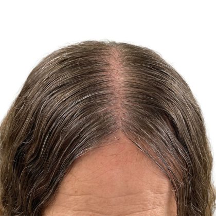 Hair Transplants Before & After Patient #3721