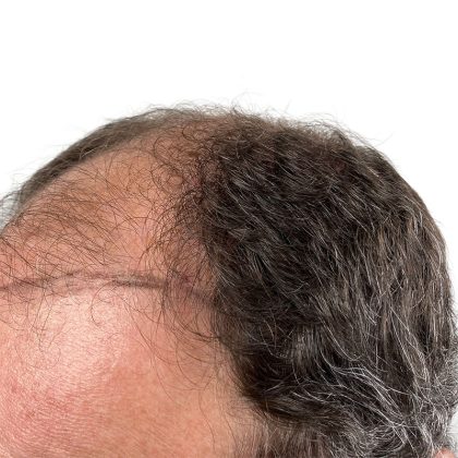 Hair Transplants Before & After Patient #3721