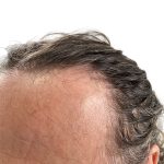 Hair Transplants Before & After Patient #3721