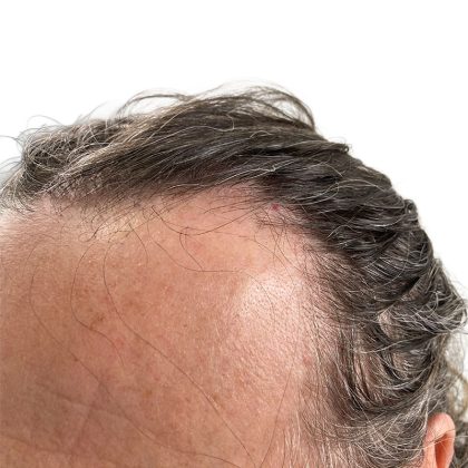 Hair Transplants Before & After Patient #3721