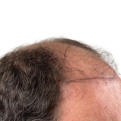 Hair Transplants Before & After Patient #3721