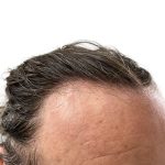 Hair Transplants Before & After Patient #3721