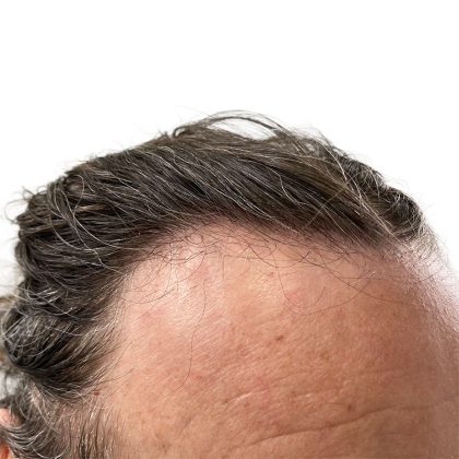 Hair Transplants Before & After Patient #3721