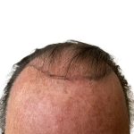 Hair Transplants Before & After Patient #3722
