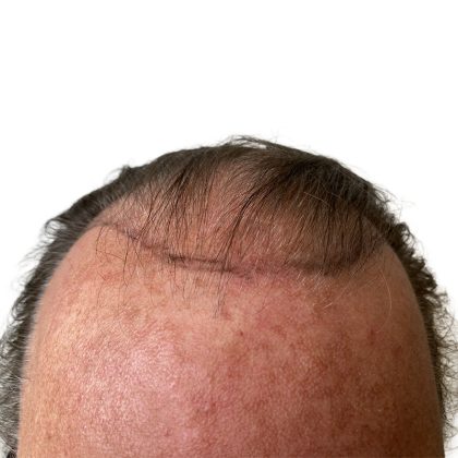 Hair Transplants Before & After Patient #3722