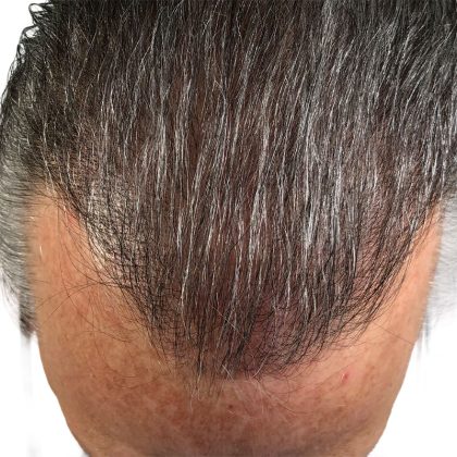 Hair Transplants Before & After Patient #3722