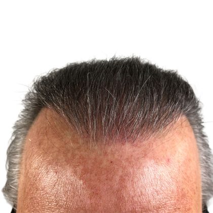 Hair Transplants Before & After Patient #3722