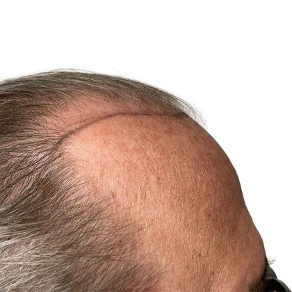 Hair Transplants Before & After Patient #3722