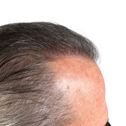 Hair Transplants Before & After Patient #3722