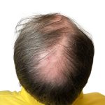 Hair Transplants Before & After Patient #3722