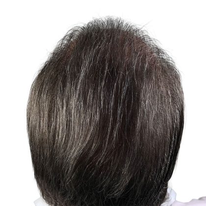 Hair Transplants Before & After Patient #3722