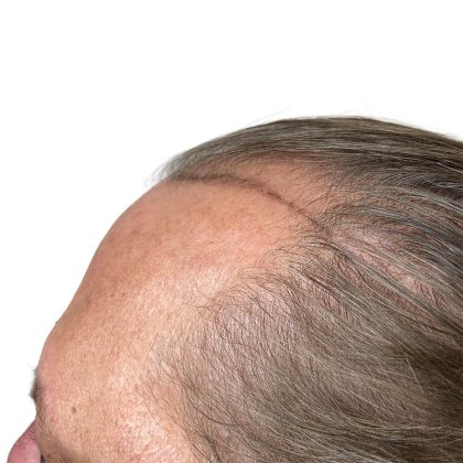 Hair Transplants Before & After Patient #3722
