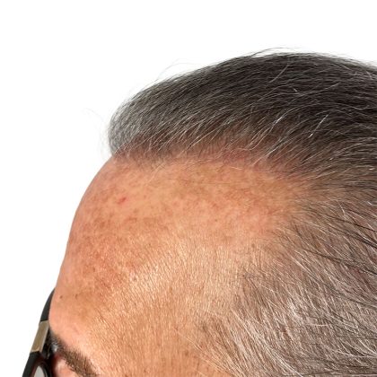 Hair Transplants Before & After Patient #3722