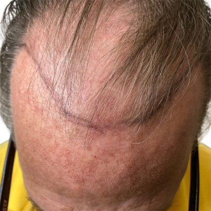 Hair Transplants Before & After Patient #3722