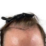 Hair Transplants Before & After Patient #3723