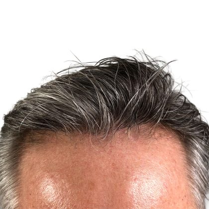 Hair Transplants Before & After Patient #3723