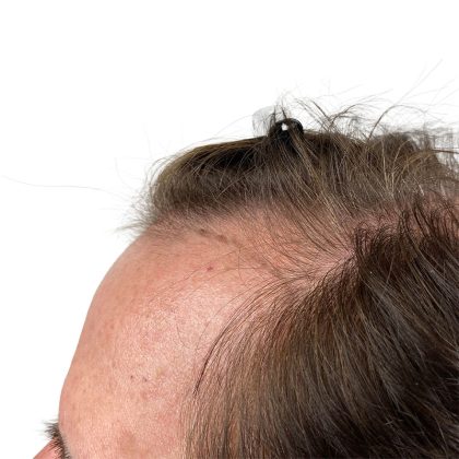 Hair Transplants Before & After Patient #3723