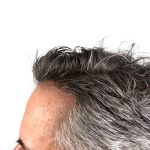 Hair Transplants Before & After Patient #3723