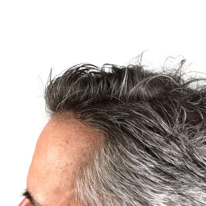 Hair Transplants Before & After Patient #3723