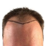 Hair Transplants Before & After Patient #3725