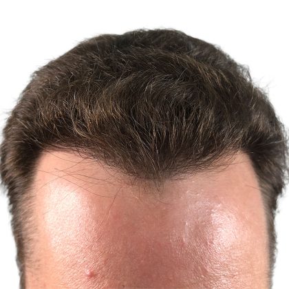 Hair Transplants Before & After Patient #3725