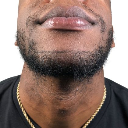 Beard Transplant Before & After Patient #3537
