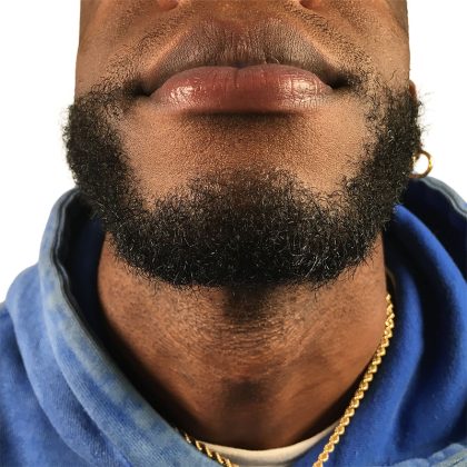 Beard Transplant Before & After Patient #3537