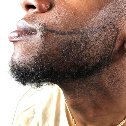 Beard Transplant Before & After Patient #3537