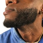Beard Transplant Before & After Patient #3537