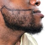 Beard Transplant Before & After Patient #3537