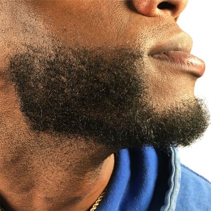 Beard Transplant Before & After Patient #3537
